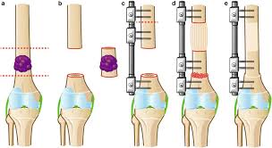 Joint Tumor and Reconstruction Surgery In Nagpur