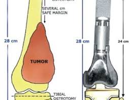 Joint Tumor and Reconstruction Surgery In Nagpur