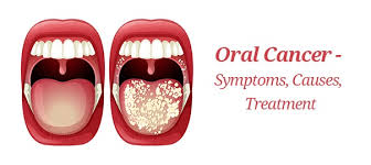 Oral Cancer Specialist In Nagpur