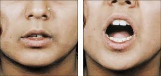 Oral Submucous Fibrosis Surgery in Nagpur