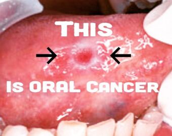 Best oral cancer hospital in ujjain