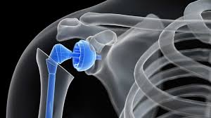 Joint Replacement Surgery Specialist in Burhanpur