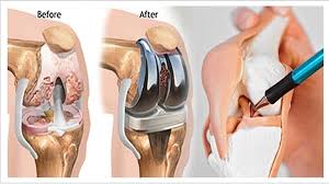 Joint Replacement Surgery Specialist in Indore