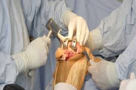 Knee Replacement Chhindwara