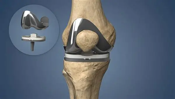 Knee replacement in buldhana