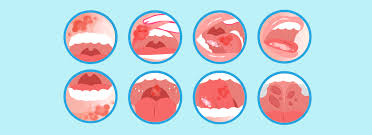 Oral Cancer Specialist Bhopal