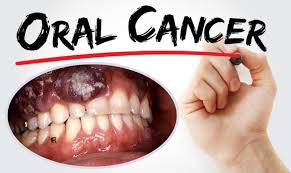 Oral Cancer Specialist Yavatmal