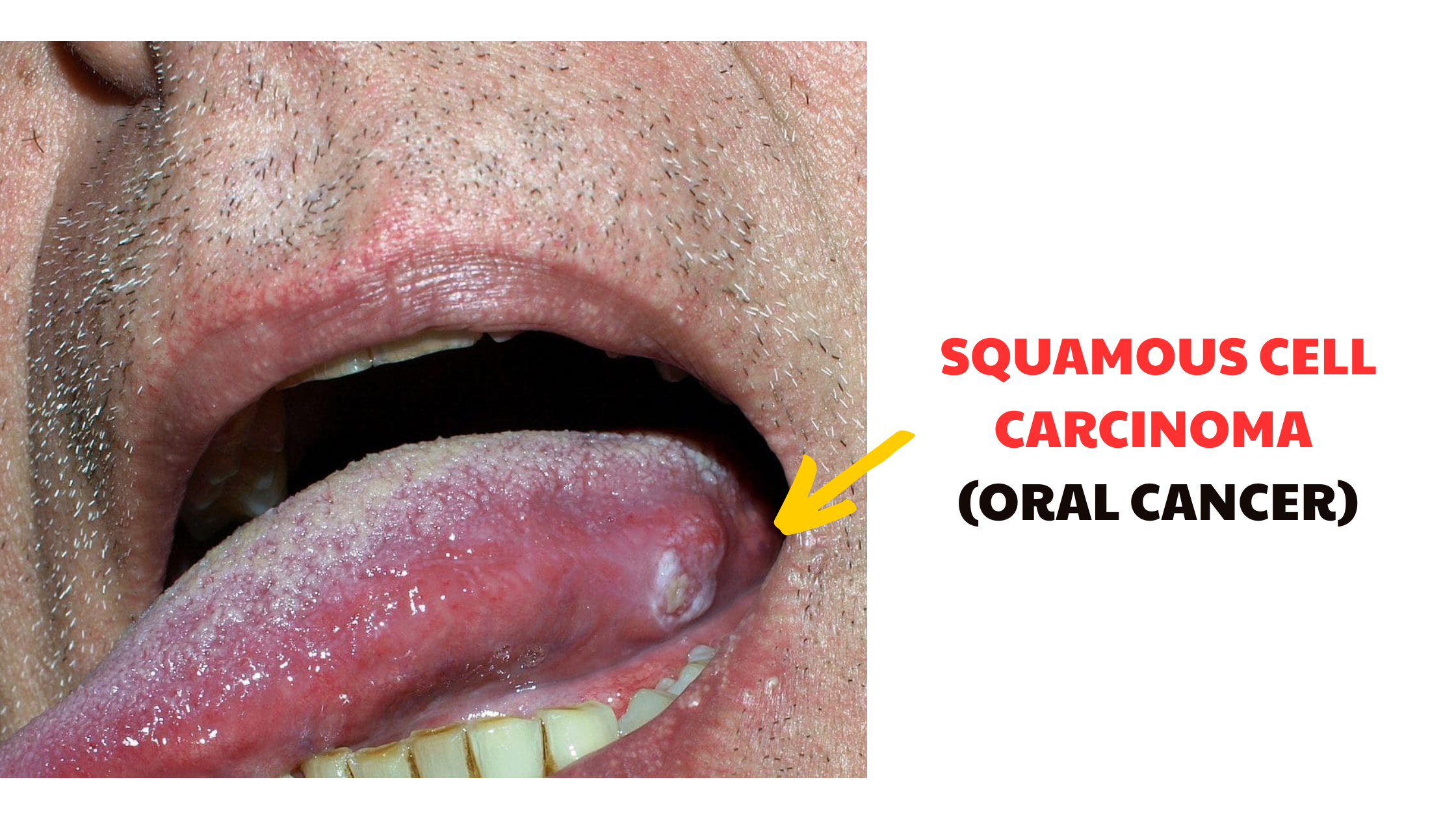 Oral cancer specialist ujjain