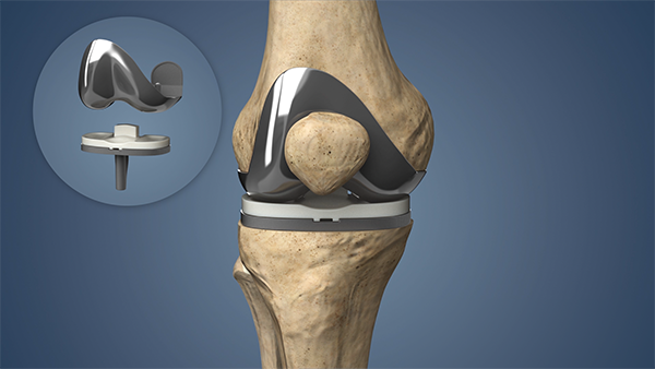 knee replacement in chandrapur