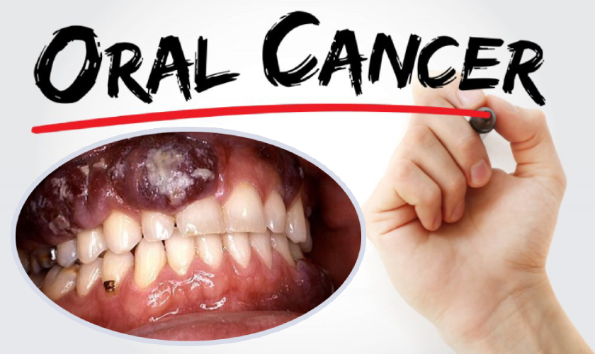 Best oral cancer hospital in hoshangabad