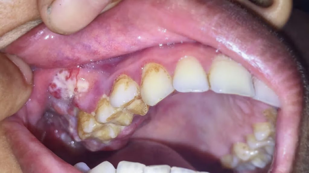 Best oral cancer hospital in itarsi