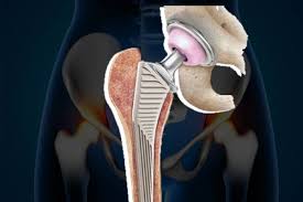 Joint Replacement Surgery Specialist in Bilaspur