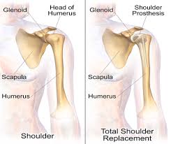 Joint Replacement Surgery Specialist in Raipur
