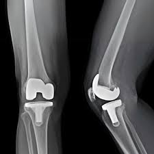 Knee Replacement Raipur
