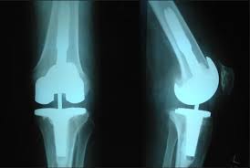 Knee Replacement Rajgarh