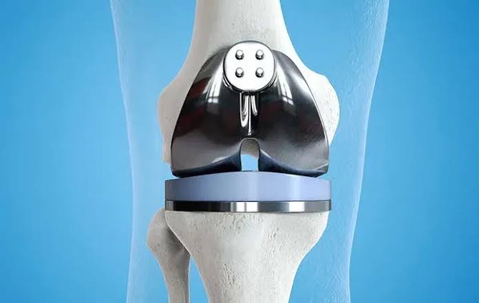 Knee replacement in itarsi