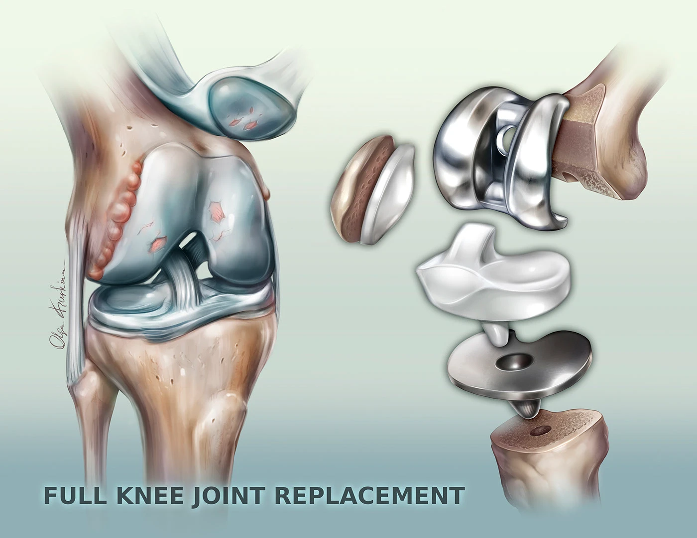 Knee replacement in mandla