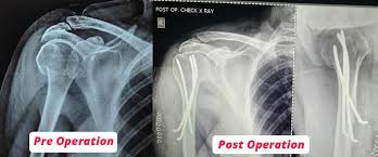 Orthopedic, Fracture & Accidental Hospital in Raipur