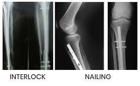 Orthopedic, Fracture & Accidental Hospital in Shajapur