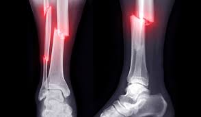 Orthopedic, Fracture & Accidental Hospital in Balaghat