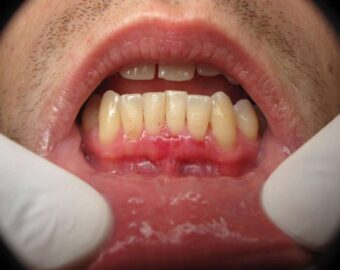 Best oral cancer hospital in chirmiri