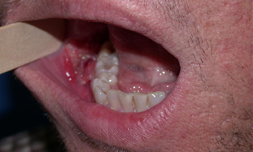 Best oral cancer hospital in kanker
