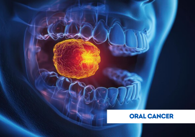 Best oral cancer specialist in kondagaon