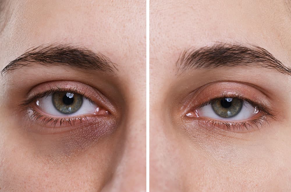 Eye hospital in chirmiri