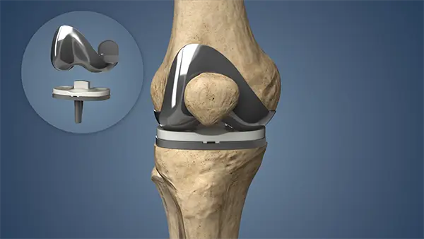 Joint replacement surgery specialist in kanker