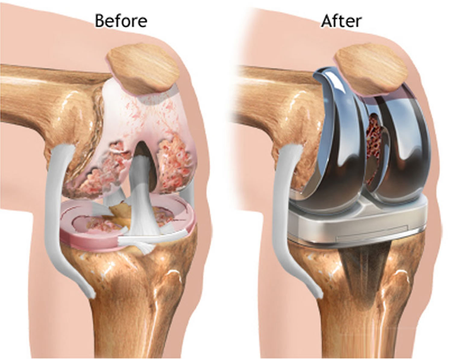 Knee replacement in ambikapur