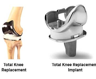 Knee replacement in dhamtari