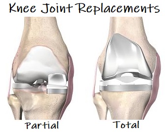 Knee replacement in kanker