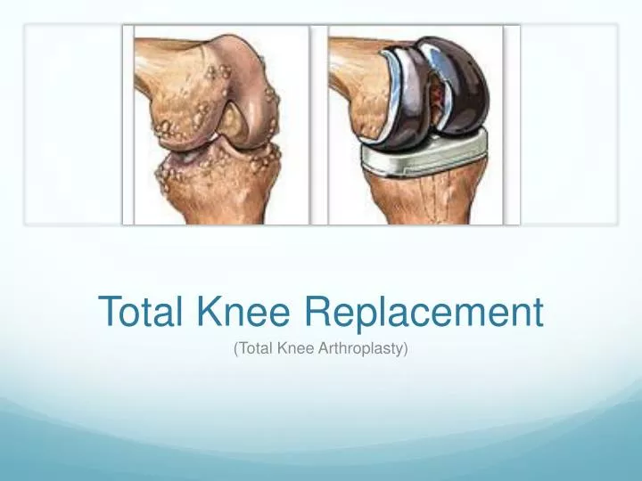 Knee replacement in korba