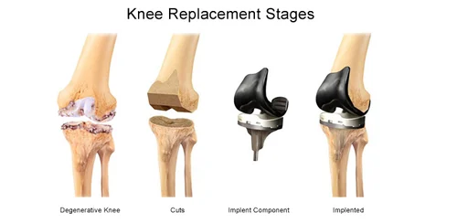 Knee replacement in raigarh