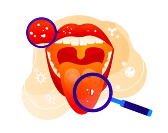 Oral cancer hospital in raigarh