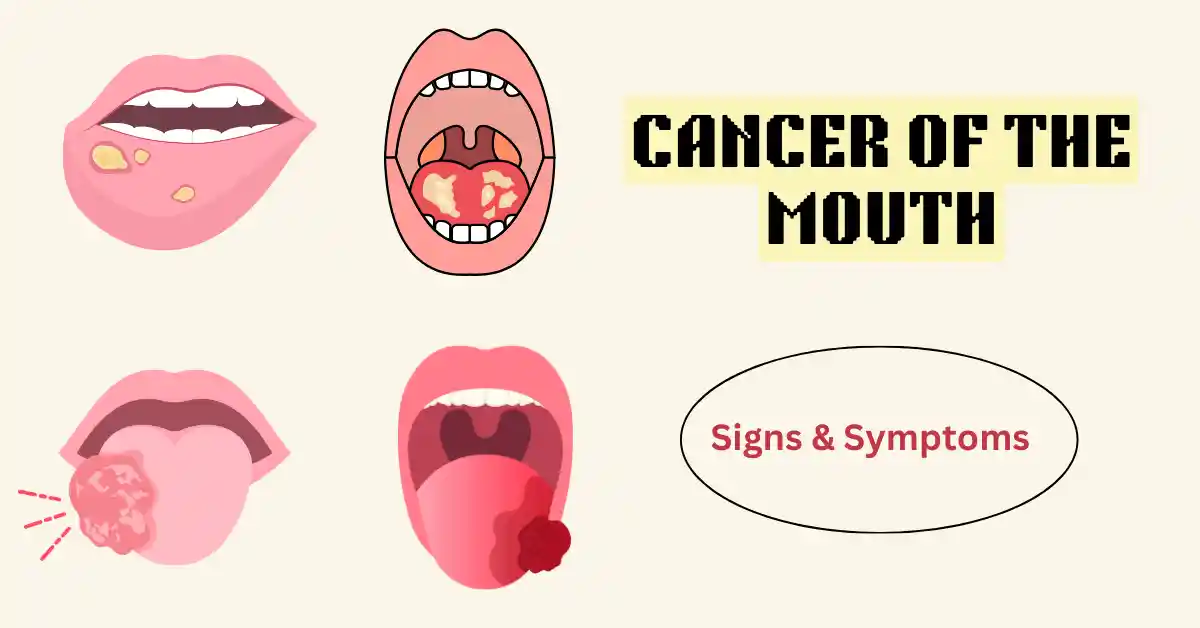 Oral cancer specialist in surajpur