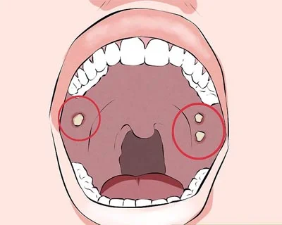 Oral cancer specialist narayanpur