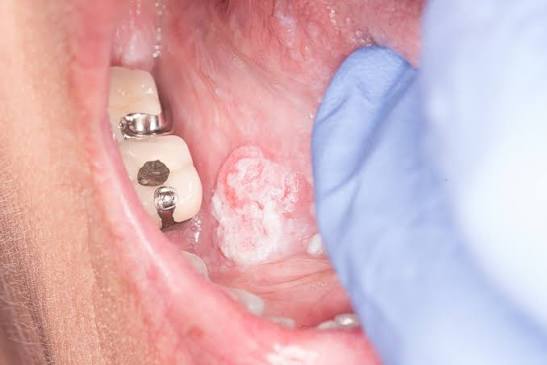 Best Oral Cancer Hospital in Maihar