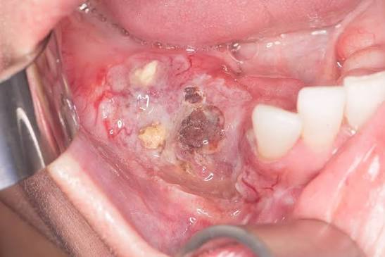Best Oral Cancer Hospital in Rajgarh