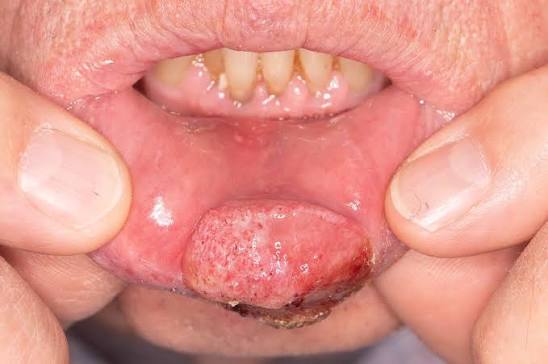 Best Oral Cancer Hospital in Shajapur