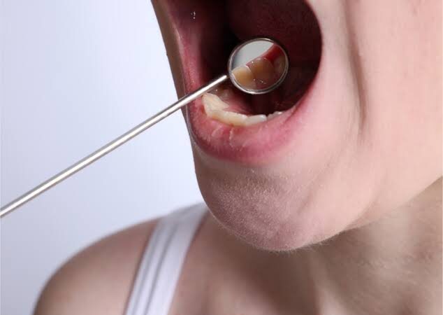 Best oral cancer hospital in yavatmal