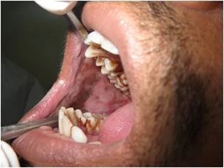 Oral Submucous Fibrosis Surgery Specialist In Nagpur
