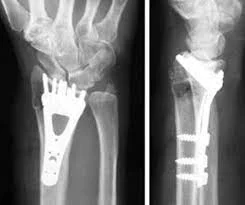 Orthopedic, Fracture & Accidental Hospital in Korba