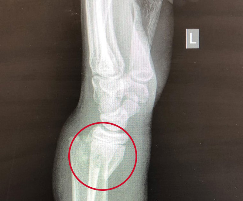 Orthopedic, Fracture & Accidental Hospital in Shajapur
