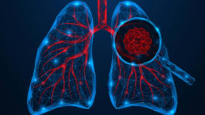 Best Cancer Surgery Specialist in Ratlam