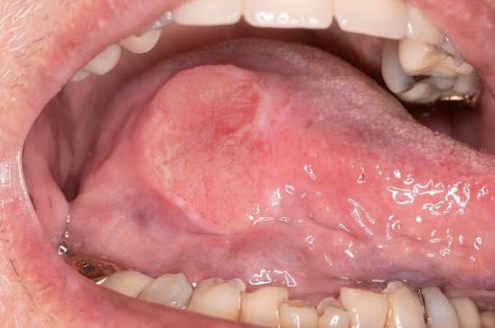 Best Oral Cancer Hospital in Betul