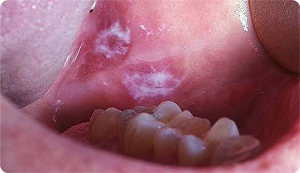 Best Oral Cancer Hospital in Guna