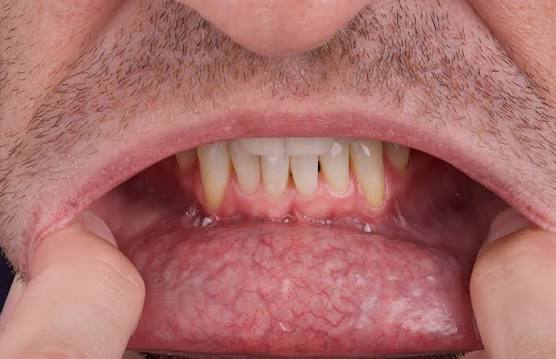 Best Oral Cancer Hospital in Vidisha