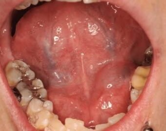 Best Oral Cancer Hospital in Vidisha