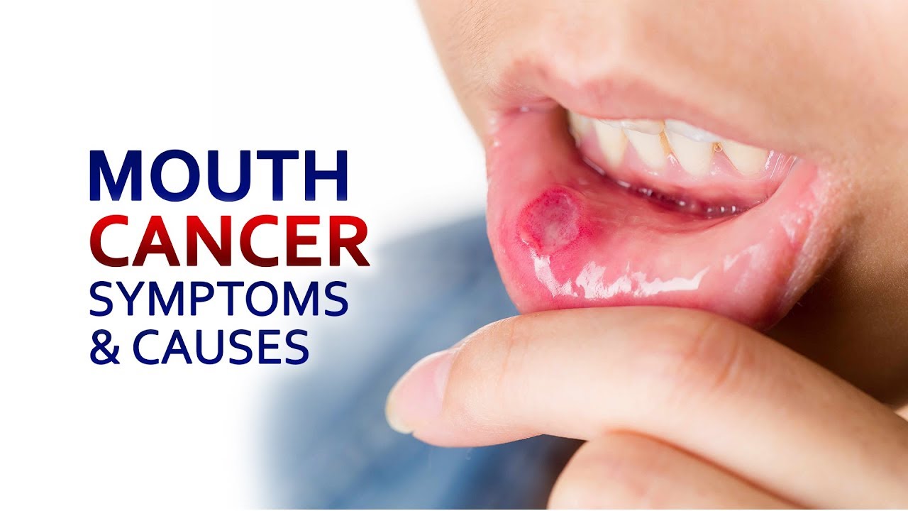 Best oral cancer hospital in satna